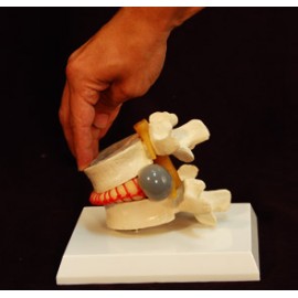Simulador vertebral con hernia discal.  (VER-00001)